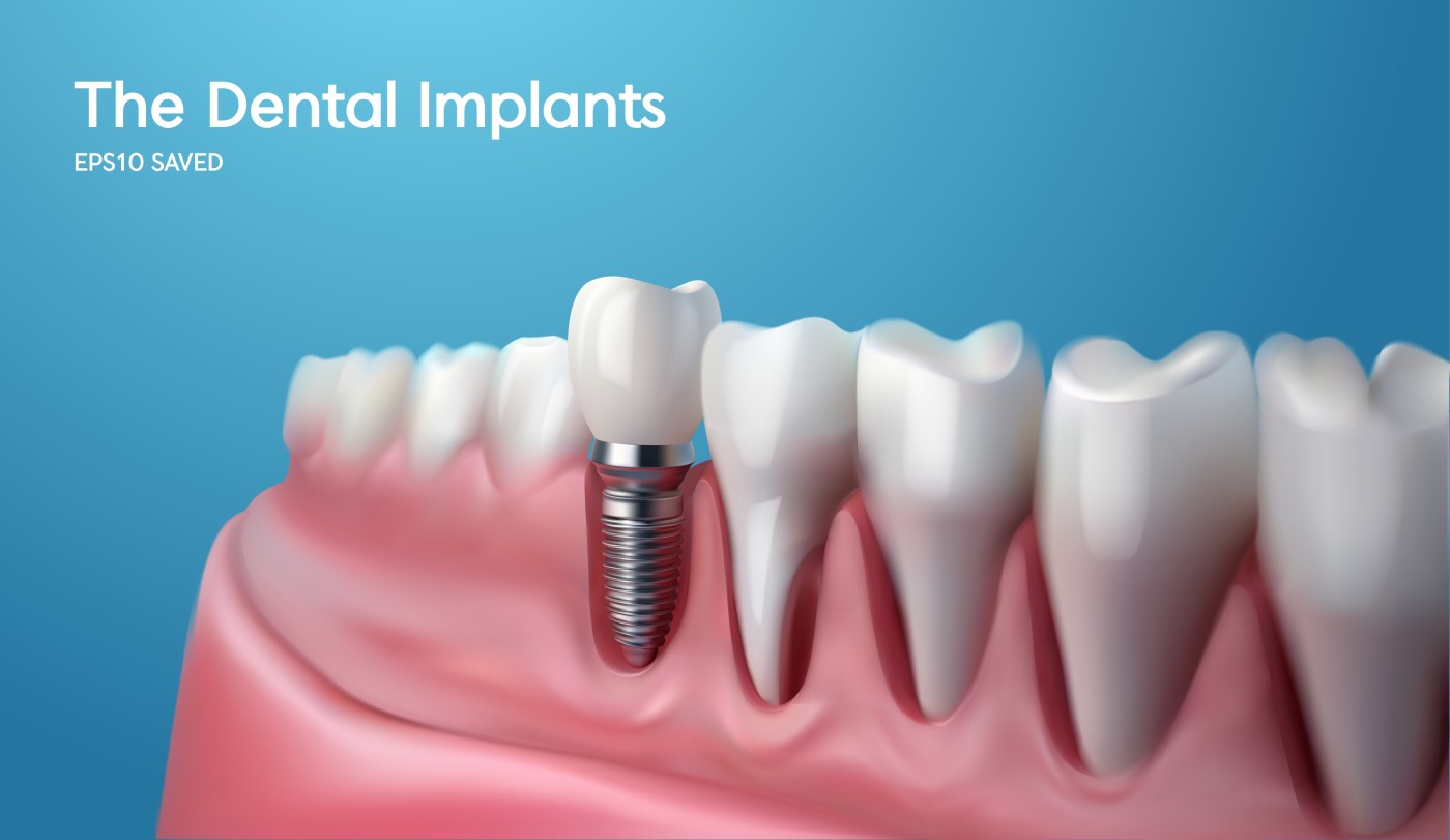 implant dentar București